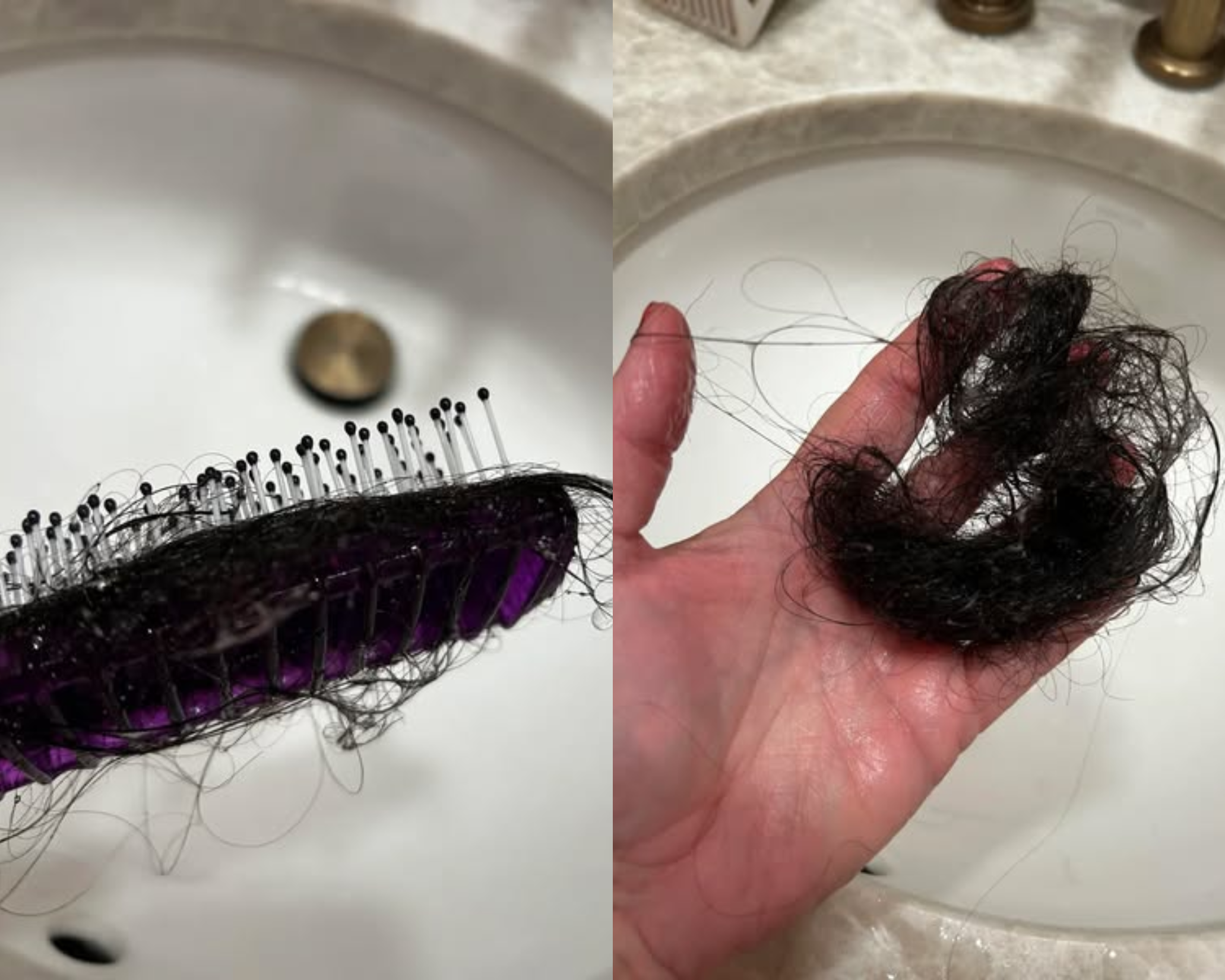 GLP-1 related hair loss — before addressing cortisol