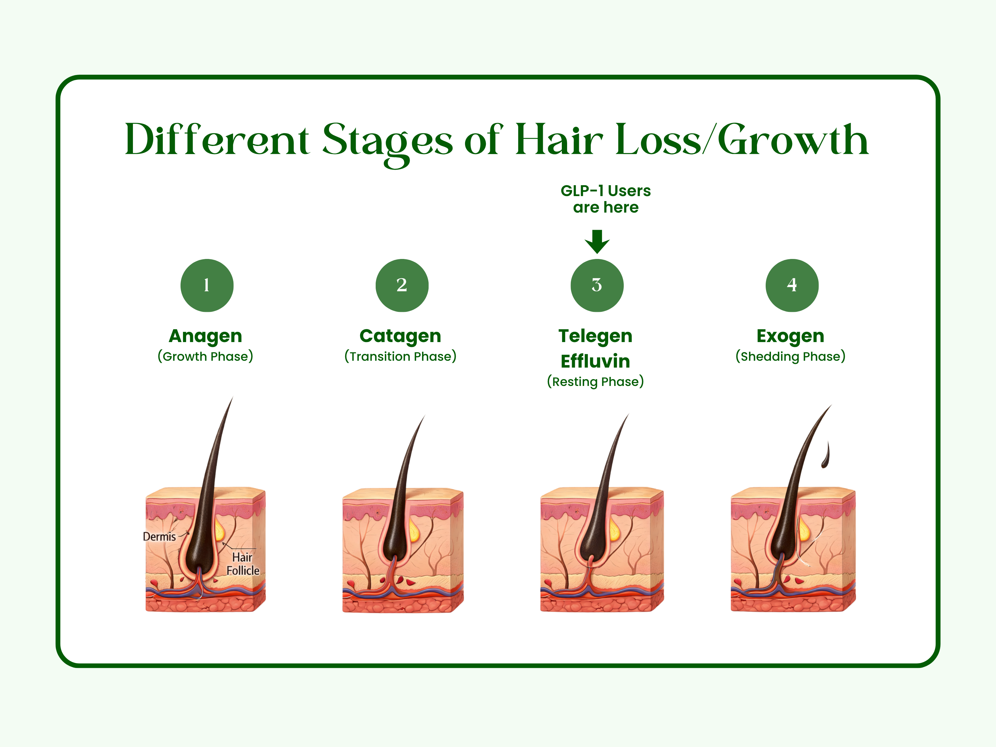 Telogen effluvium hair shedding